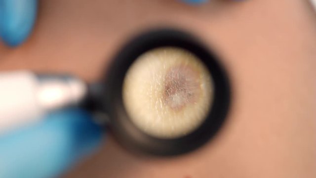 Inspecting hemangioma through dermatoscope magnifier