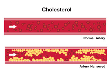 Cholesterol in artery, health risk , vector design