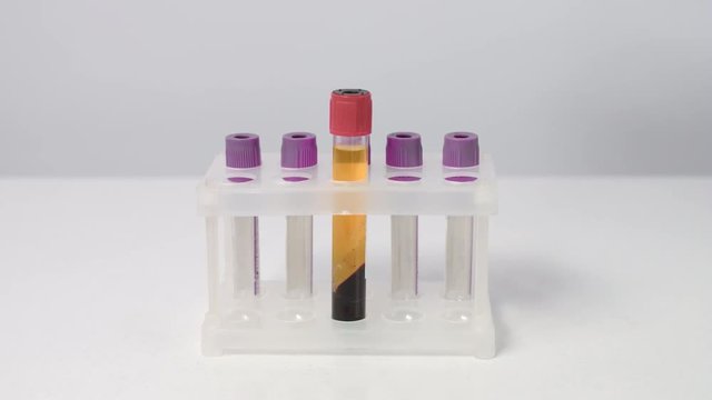 Putting two test tubes with centrifuged blood plasma in rack