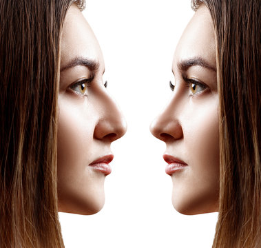Young woman in profile before and after rhinoplasty.