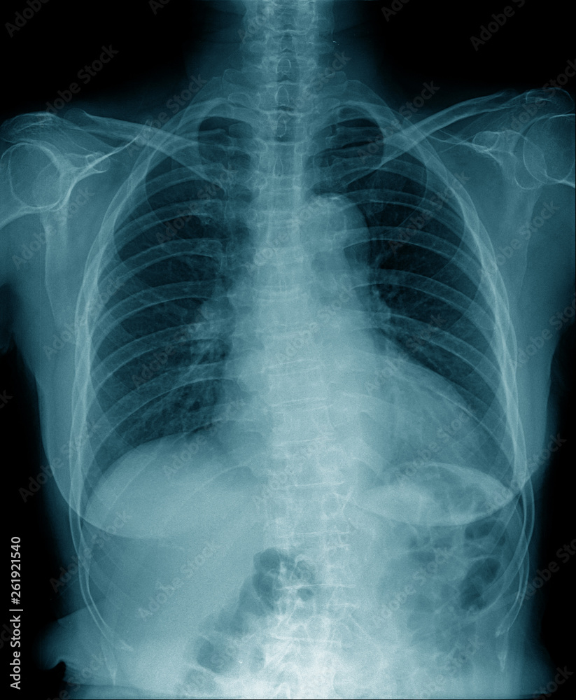 Canvas Prints chest x-ray , hight quality chest x-ray image in blue tone