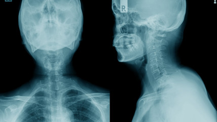 x-ray c-spine, case cervical spondylosis x-ray image © angkhan