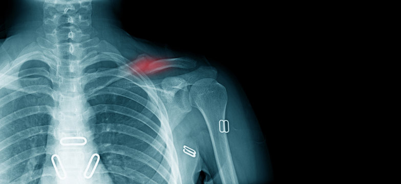 x-ray clavicle fracture, accident of old man at shoulder part