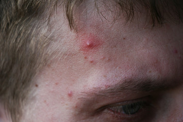 Obraz premium acne, problem skin of men