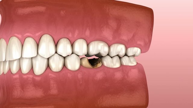 Losing molar tooth. 3D animation of human teeth and dentures concept