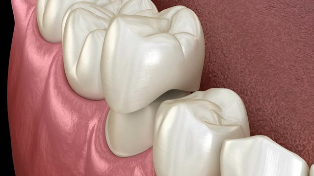 Preparated premolar tooth for dental crown placement. Medically accurate  3D animation