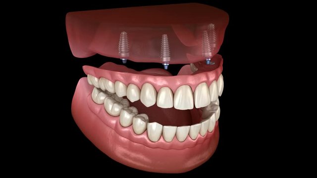 Maxillary prosthesis All on 4 system supported by implants. Medically accurate 3D animation of human teeth and dentures concept