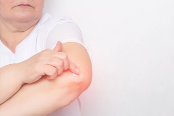 A woman rubs an anti-inflammatory treatment ointment into the elbow joint to relieve pain and inflammation, treatment of the elbow joint with a cream, chondrocalcinosis, copy space
