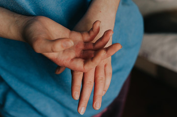 Woman sick hands. Scabies in hands