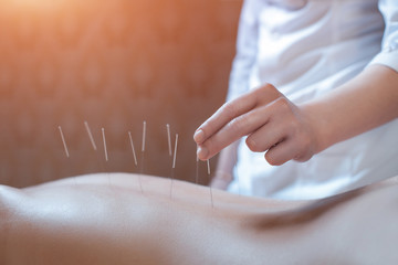 needle acupuncture procedure; - obrazy, fototapety, plakaty