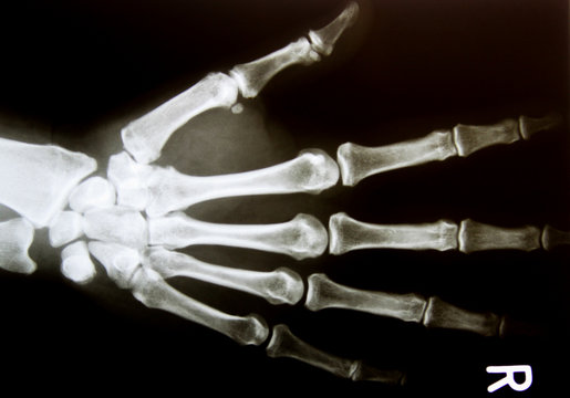 X-ray image of healthy normal human hand