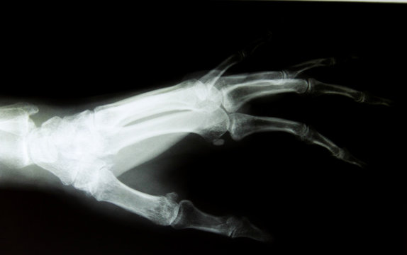 X-ray image of healthy normal human hand