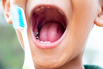 Boy or children have problem with teeth about caries