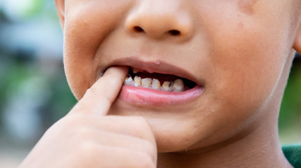 Boy or children have problem with teeth about caries