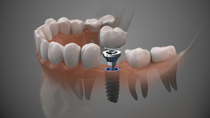 Tooth human implant. On1 concept. Dental prosthetic innovation. 3d illustration. - obrazy, fototapety, plakaty