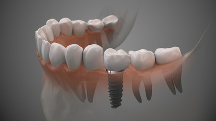 Tooth human implant. On1 concept. Dental prosthetic innovation. 3d illustration.