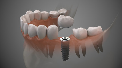 Tooth human implant. On1 concept. Dental prosthetic innovation. 3d illustration.