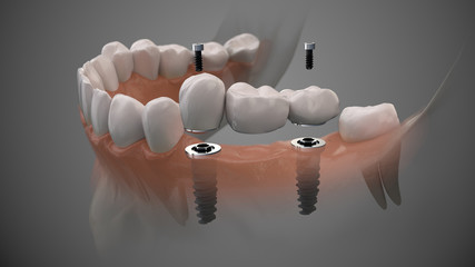 Tooth bridge human implant. Dental prosthetic innovation. 3d illustration. - obrazy, fototapety, plakaty