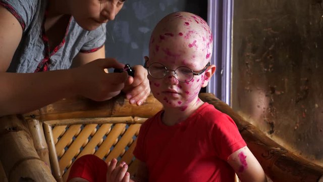 Funny blond child with glasses has chicken pox. Mom smears follicles with pink solution of takkelani all over her body. Baby is sitting on  chair waiting for end of procedure. Chickenpox.