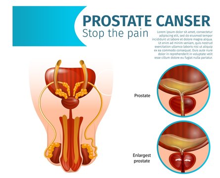 Healthy and Inflamed Prostate Gland. Cancer.