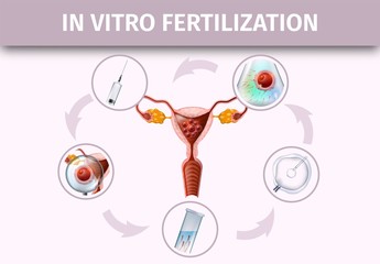 Human In Vitro Fertilization Stages Infographic.