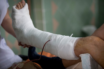 broken leg in plaster bandage in the operating room