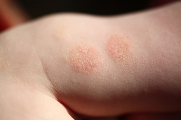 Atopic dermatitis in a child