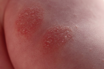 Atopic dermatitis in a child