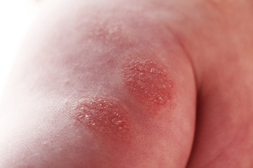 Fototapeta premium Atopic dermatitis in a child