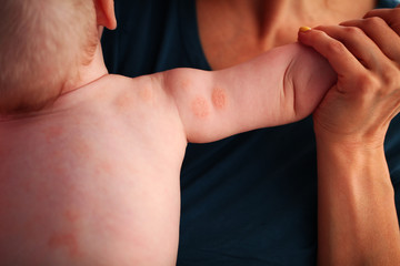 Atopic dermatitis in a child