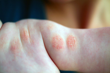 Fototapeta premium Atopic dermatitis in a child