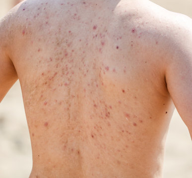 Man with acne on his back