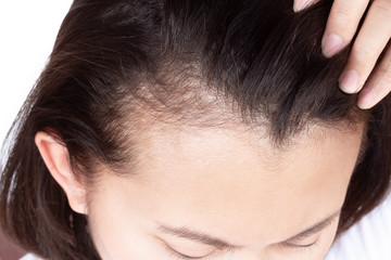 Fototapeta premium Woman serious hair loss problem for health care shampoo and beauty product concept, selective focus