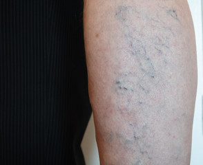 Fototapeta premium closeup of old man's leg with capillary mesh which cause varicose veins
