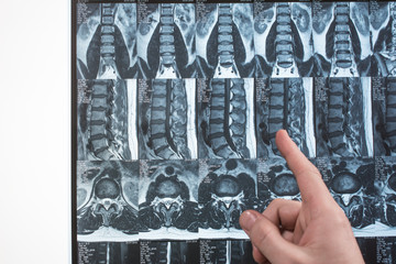 Doctor hand shows something on MRI results (magnetic resonance therapy)