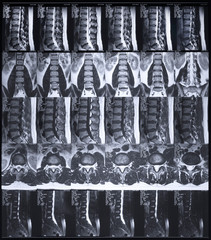 Magnetic resonance tomography (MRT) of the lumbar spine. Hernia of the lumbar spine. Schmorl defects in bodies L3 and L5. Herniated intervertebral disc L5 / S1.