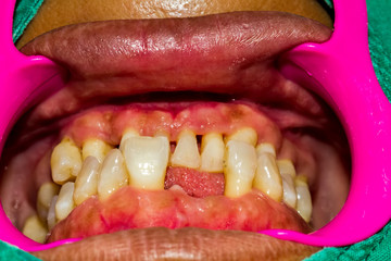 Close up human patient open mouth showing caries teeth decay with gingivitis.