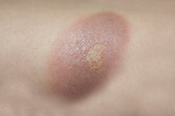 burn wound on woman skin