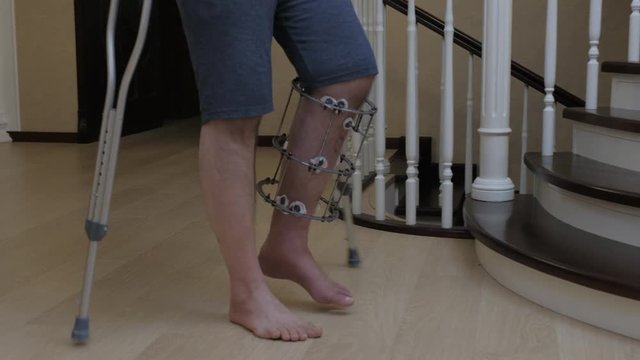 Climbing the stairs on crutches with a broken leg in the Ilizarov's external fixator