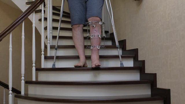 Climbing the stairs on crutches with a broken leg in the Ilizarov's external fixator	