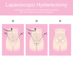 Laparoscopic hysterectomy is a less invasive procedure than open surgery and recovery is quicker.
