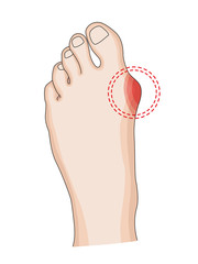 Hallux © ZYTA.eM