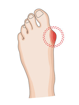 Hallux