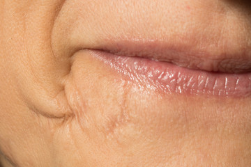 An extreme closeup view of an old and well healed scar by the lips of a Caucasian woman, healthcare...