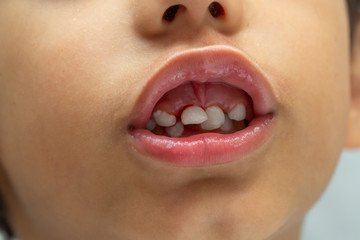A close up view on the mouth of a preschool child with loosened and bleeding front teeth. Childhood dentistry concept.