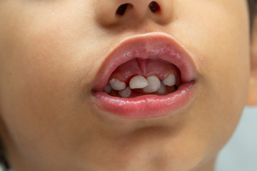 Naklejka premium A close up view on the mouth of a preschool child with loosened and bleeding front teeth. Childhood dentistry concept.