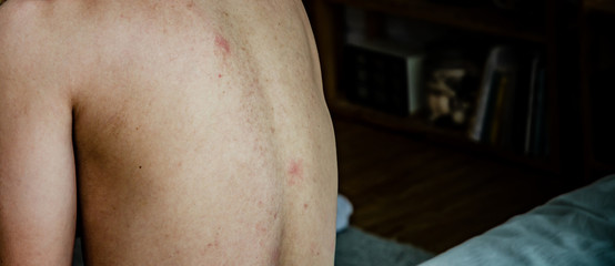 The back of Asian men, it's skin problem.