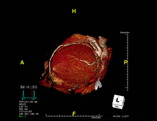 CTA Coronary artery  3D rendering image from the screen . CT angiographphy for heart Vessel disease .