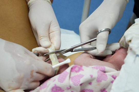 Cutting the umbilical cord between a newborn baby and placenta.