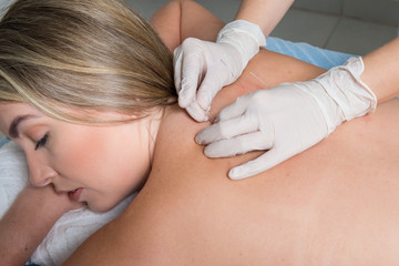 The doctor sticks needles into the blonde girl's body on the acupuncture.